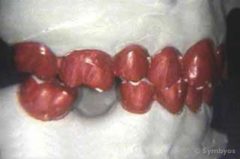 Diagnostic equilibration is first performed on casts of the teeth in dental malocclusion.