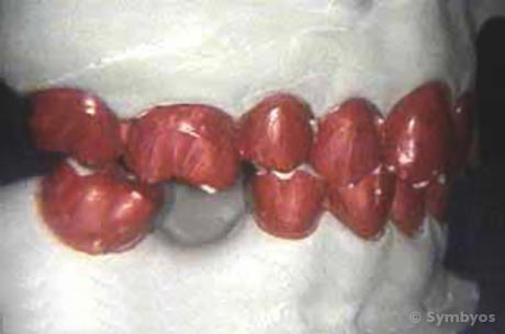 dental-equilibration-occlusal-adjustment-diagnostic-casts-teeth