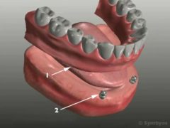 A removable complete denture attached to two dental implants.