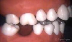 Skeletal open bite malocclusion shows only back teeth touch.