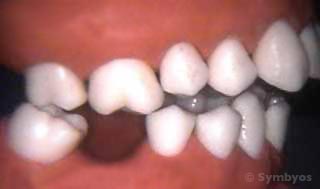 dental-malocclusion-skeletal-open-bite