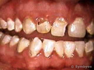 Dental neglect causes many problems.