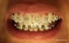 Tooth colored orthodontic brackets, upper teeth; Metal brackets, lower teeth.