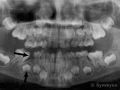 Dental panoramic X-ray of a developing child shows premature tooth (and space) loss.
