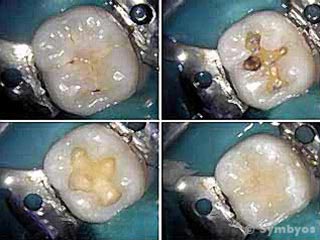 Dental photographs taken with intraoral cameras helps communicate problems to patients.