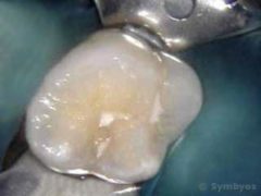 Dental sealant in this molar tooth appears intact, masking caries (cavity) beneath it.