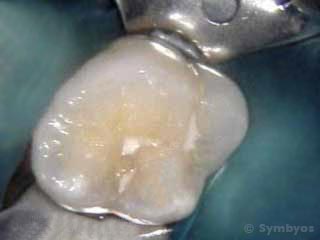 dental-sealant-molar-tooth-appears-intacts-caries-beneath-320