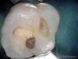 dental-sealant-molar-tooth-leaked-removed-large-cavity-caries-320