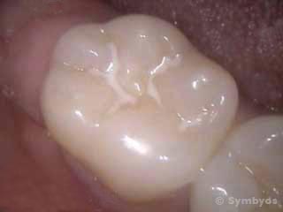 dental-sealant-preventive-resin-molar-teeth-cavities-320