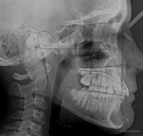 Orthodontic tracings on a lateral cephalometric X-ray (radiograph).