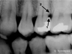 Dental x-ray shows overcontoured silver filling in tooth causing periodontal pocket.