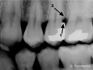 dental-x-ray-overhang-silver-filling-contour-tooth-periodontal