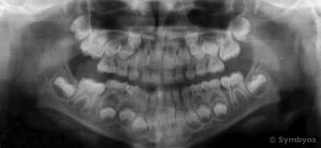 dental-x-ray-panoramic-radiograph-orofacial-development