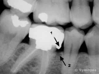 An example of poorly contoured dental restorations: Dental x-ray of overcontoured crown on tooth with plaque trap caused perio pocket.