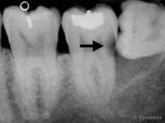 A dental periapical X-ray (radiograph) showing tooth decay (caries).