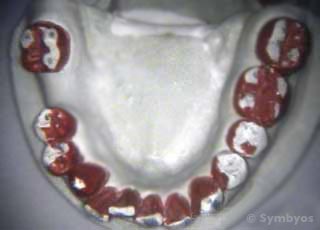 Diagnostic equilibration on dental study models (casts) before teeth are adjusted.