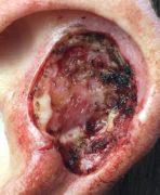 Basil cell carcinoma on the ear