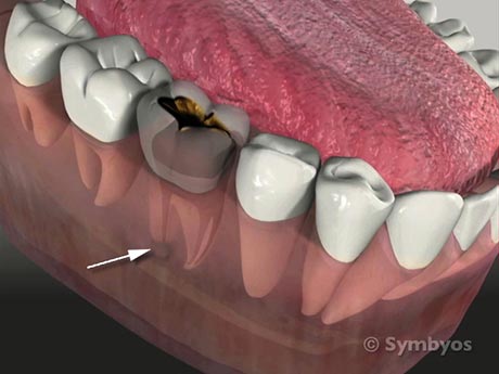 Root canal therapy removes micro-organisms, relieves pain, and prevents reoccurrences.