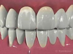 Sensitive teeth: Gingival recession produces exposed tooth roots which can be very sensitive.