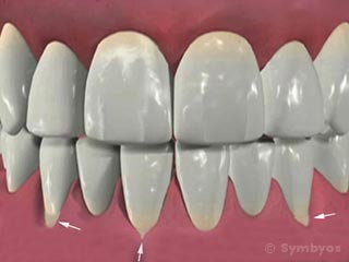 exposed-tooth-root-dentin-hypersensitivity-320