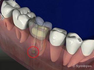 Failing or root canal (endodontic treatment) of a tooth with a prefabricated post and core.