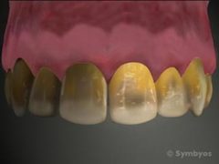 Severe fluorosis often appears as brown intrinsic stains in the teeth.