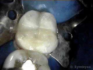 A fractured lower molar tooth with caries restored with white composite resin filling.