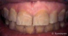 Gray teeth with tetracycline intrinsic stain can be covered by porcelain veneers.