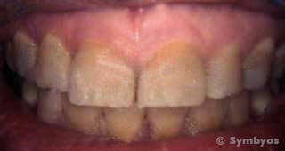 gray-teeth-tetracycline-intrinsic-stain-porcelain-veneers