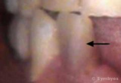 Intrinsic stain of dentin from hyperemia after dental injury that left the tooth dead (necrotic).