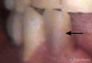 intrinsic-stain-tooth-dentin-hyperemia-dental-injury-necrotic