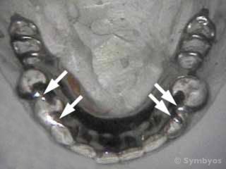 metal-partial-denture-framework-reinforce-replacement-teeth