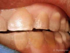 Minimally invasive porcelain veneer preps of tetracycline stained teeth.