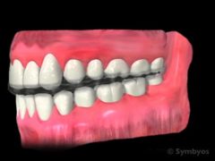 Night guards (occlusal guards) help the dental treatment of TMD and bruxism.