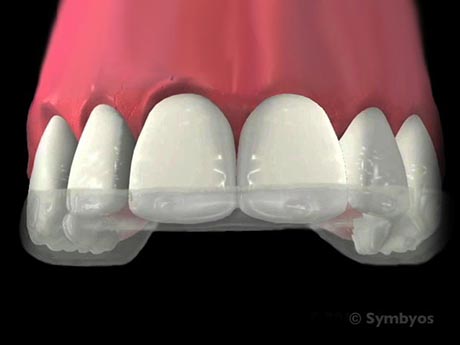 Night guards (occlusal guards) protect teeth and jaw joints.