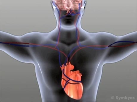 oral-systemic-health-issues-stroke-heart-attack