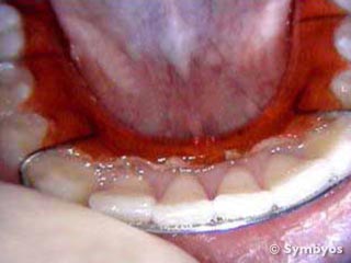 orthodontic-hawley-retainer-braces-removed-lower-teeth