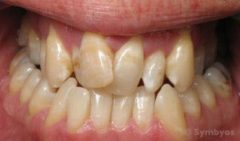 Reverse occlusion due to skeletal and dental malocclusion arch constriction.