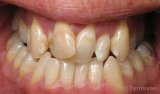 Reverse occlusion due to skeletal and dental malocclusion arch constriction.