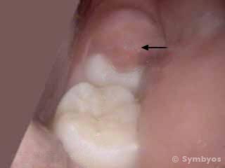 Pericoronitis, a dental infection common around wisdom teeth needing extraction.