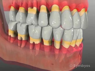 periodontal-disease-toothiq-320