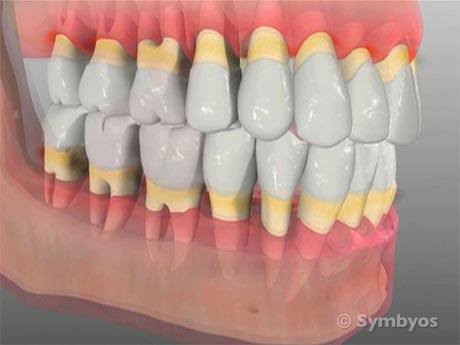 periodontal-disease-toothiq