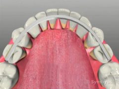 Periodontal stabilization splints can significantly reduce the forces on remaining teeth.