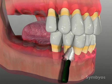periodontal-stabilization-splints-special-hygiene-aids-may-be-required-to-clean-properly