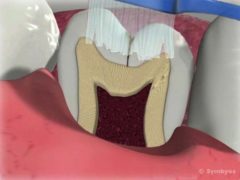 Sectioned tooth shows fissure smaller than single toothbrush bristle, making it difficult to clean.