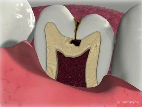 pit-fissure-tooth-cavity-460