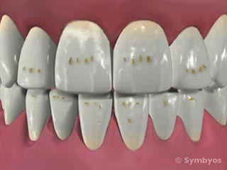 Brown spots and pitted irregular tooth enamel are commonly observed in vitamin D resistant rickets and renal failure.