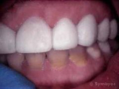 Porcelain veneers are cosmetic dentistry tools to hide gray tetracycline stained teeth.
