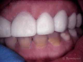 porcelain-veneers-cosmetic-dentistry-gray-tetracycline-stains-teeth-320