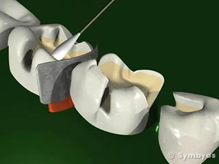Post-operative sensitivity can often be avoided by application of desensitizing agents at the time fillings are placed.